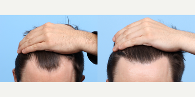 Case 8520 - 25-34 year old man treated with FUE Hair Transplant, Hair Transplant, Hair Loss Treatment, PRP for Hair Loss