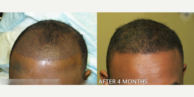 Case 8521 - Man treated with Hair Transplant, ARTAS Robotic Hair Transplant