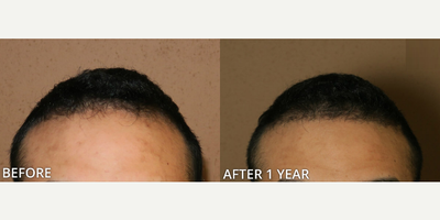 Case 8522 - Man treated with Hair Transplant, ARTAS Robotic Hair Transplant