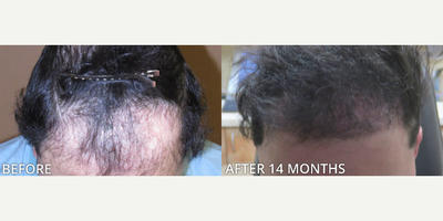 Case 8523 - Man treated with Hair Transplant, ARTAS Robotic Hair Transplant