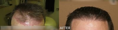 Case 8524 - Man treated with Hair Transplant, ARTAS Robotic Hair Transplant