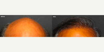 Case 8525 - Man treated with Hair Transplant