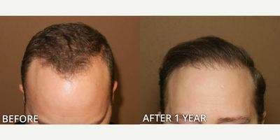 Case 8527 - Man treated with Hair Transplant, FUE Hair Transplant