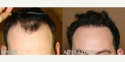 Case 8528 - Man treated with Hair Transplant, FUE Hair Transplant