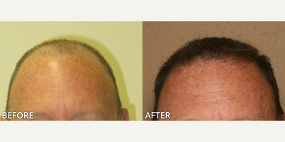 Case 8529 - Man treated with Hair Transplant, ARTAS Robotic Hair Transplant