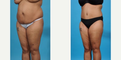Case 853 - 35-44 year old woman treated with Tummy Tuck, Mommy Makeover, Liposuction