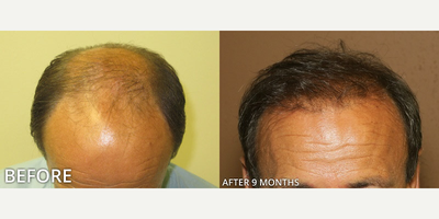 Case 8530 - Man treated with Hair Transplant, ARTAS Robotic Hair Transplant