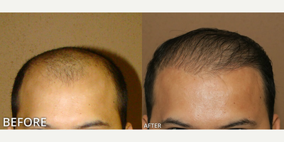 Case 8531 - Man treated with Hair Transplant, ARTAS Robotic Hair Transplant
