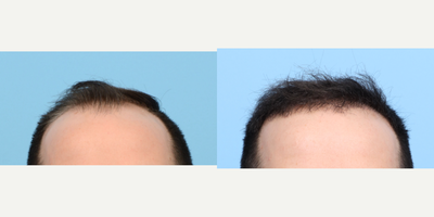 Case 8532 - 25-34 year old man treated with FUE Hair Transplant, Hair Transplant, Hair Loss Treatment, PRP for Hair Loss, PRP Injections