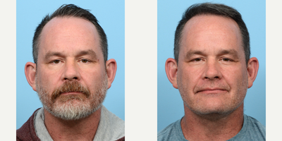 Case 8533 - 45-54 year old man treated with FUE Hair Transplant, Hair Transplant, Hair Loss Treatment, PRP for Hair Loss, PRP Injections
