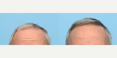 Case 8534 - 65-74 year old woman treated with FUE Hair Transplant, Hair Transplant, Hair Loss Treatment, PRP for Hair Loss, PRP Injections