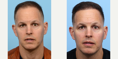 Case 8535 - 45-54 year old man treated with FUE Hair Transplant, Hair Transplant, Hair Loss Treatment, PRP for Hair Loss, PRP Injections