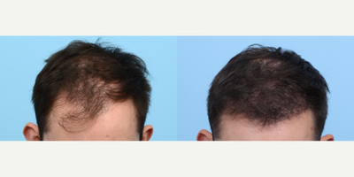 Case 8536 - 18-24 year old man treated with FUE Hair Transplant, Hair Transplant, Hair Loss Treatment, PRP for Hair Loss, PRP Injections