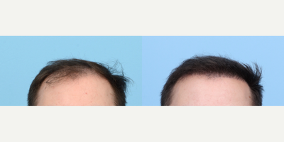 Case 8537 - 18-24 year old man treated with FUE Hair Transplant, Hair Transplant, Hair Loss Treatment, PRP for Hair Loss, PRP Injections
