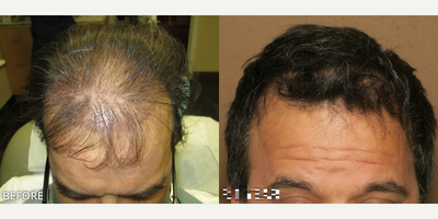 Case 8538 - Man treated with Hair Transplant, ARTAS Robotic Hair Transplant