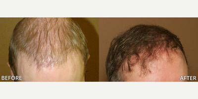 Case 8539 - Man treated with Hair Transplant, ARTAS Robotic Hair Transplant