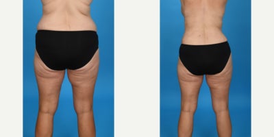 Case 854 - 35-44 year old woman treated with Tummy Tuck, Drainless Tummy Tuck, Liposuction, Mommy Makeover