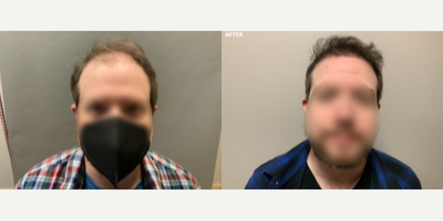 Case 8540 - Man treated with Hair Transplant