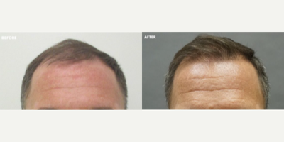 Case 8541 - Man treated with Hair Transplant