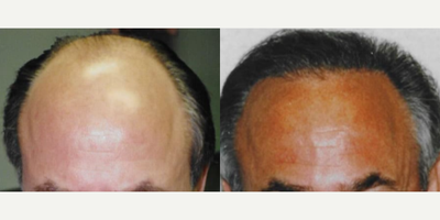 Case 8543 - Man treated with Hair Transplant