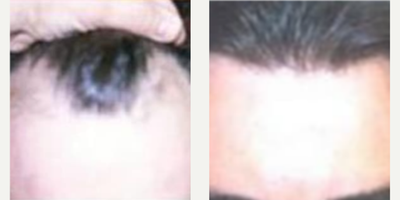 Case 8544 - Man treated with Hair Transplant