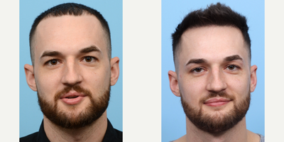 Case 8545 - 25-34 year old man treated with FUE Hair Transplant, Hair Transplant, Hair Loss Treatment, PRP for Hair Loss