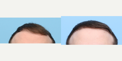 Case 8546 - 25-34 year old man treated with FUE Hair Transplant, Hair Transplant, Hair Loss Treatment, PRP for Hair Loss, NeoGraft