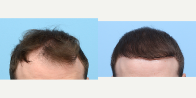 Case 8547 - 25-34 year old man treated with FUE Hair Transplant, Hair Transplant, Hair Loss Treatment, PRP for Hair Loss, NeoGraft