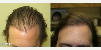 Case 8548 - Man treated with Hair Transplant, FUE Hair Transplant