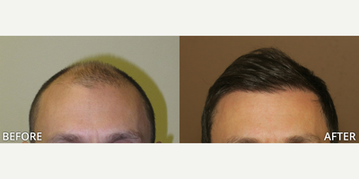Case 8549 - Man treated with Hair Transplant, FUE Hair Transplant