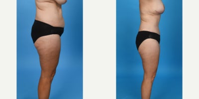 Case 855 - 35-44 year old woman treated with Tummy Tuck, Drainless Tummy Tuck, Liposuction, Mommy Makeover