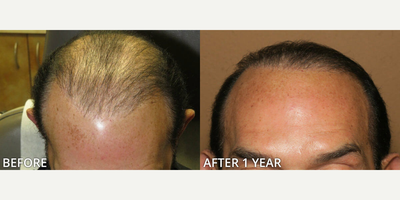 Case 8550 - Man treated with Hair Transplant, FUE Hair Transplant