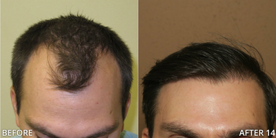 Case 8551 - Man treated with Hair Transplant, FUE Hair Transplant