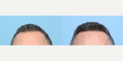 Case 8552 - 45-54 year old man treated with FUE Hair Transplant, Hair Transplant, Hair Loss Treatment