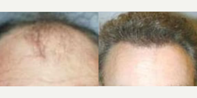 Case 8553 - Man treated with Hair Transplant