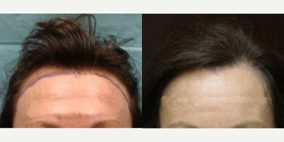 Case 8554 - Man treated with Hair Transplant