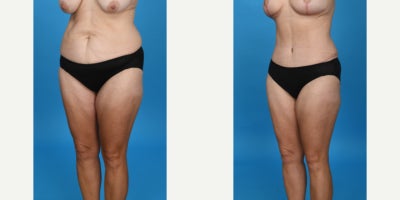 Case 856 - 35-44 year old woman treated with Tummy Tuck, Drainless Tummy Tuck, Liposuction, Mommy Makeover
