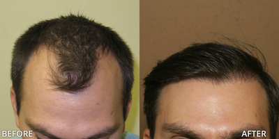 Case 8565 - Man treated with Hair Transplant