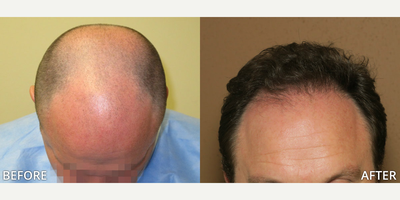 Case 8566 - Man treated with Hair Transplant