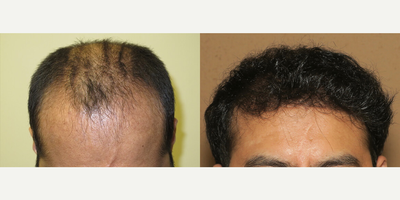 Case 8567 - Man treated with Hair Transplant
