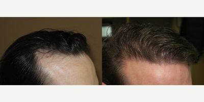 Case 8568 - Woman treated with Hair Transplant