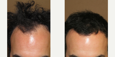 Case 8569 - Woman treated with Hair Transplant