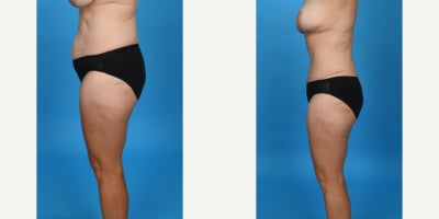 Case 857 - 35-44 year old woman treated with Tummy Tuck, Drainless Tummy Tuck, Liposuction, Mommy Makeover