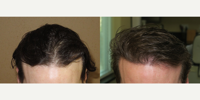 Case 8570 - Woman treated with Hair Transplant