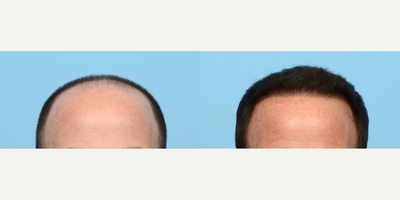 Case 8571 - 45-54 year old man treated with FUE Hair Transplant, Hair Transplant, Hair Loss Treatment, PRP for Hair Loss