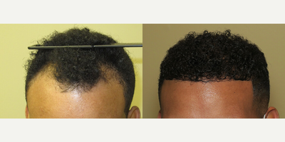 Case 8572 - Man treated with Hair Transplant