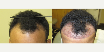 Case 8573 - Man treated with Hair Transplant