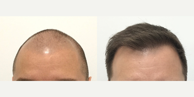 Case 8574 - Man treated with Hair Transplant