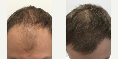 Case 8575 - Man treated with Hair Transplant