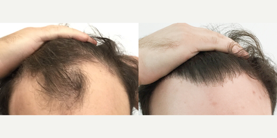 Case 8576 - Man treated with Hair Transplant